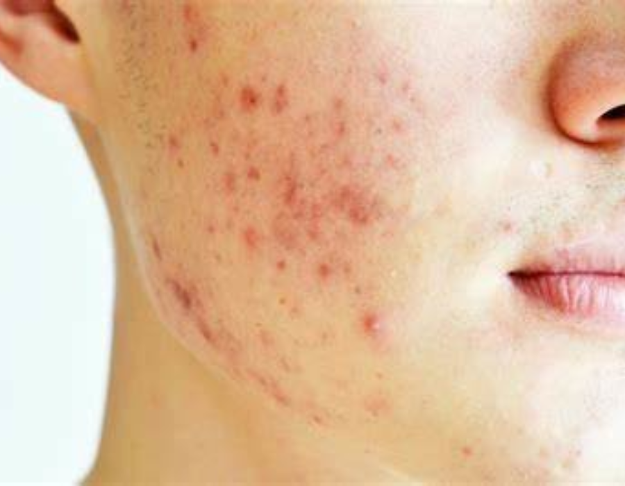 How to Prevent Acne Scars Naturally