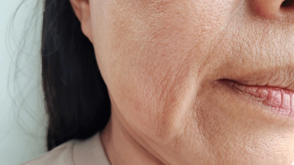 Aged Skin Treatment
