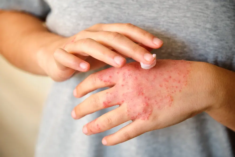 Eczema Treatment