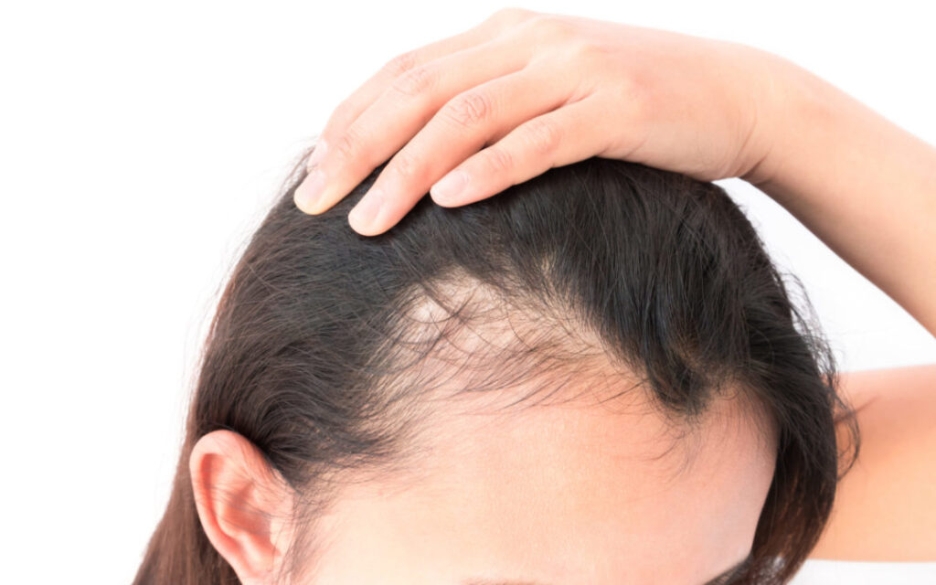 Hair Loss Treatment