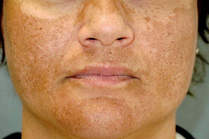 Skin Pigmentation Disorders