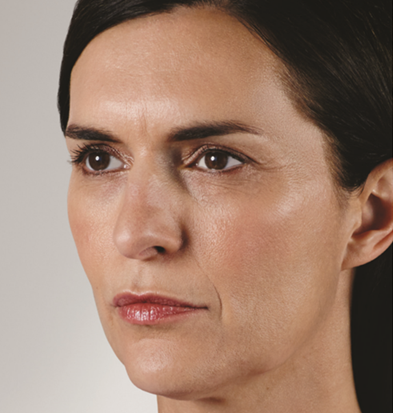 Dermal Fillers before