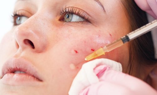 Vampire Facial