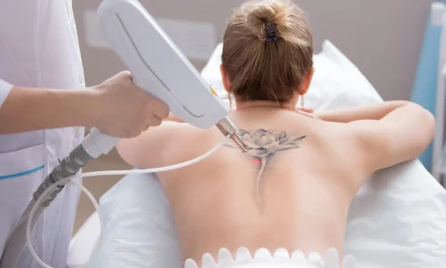 Laser Tattoo Removal